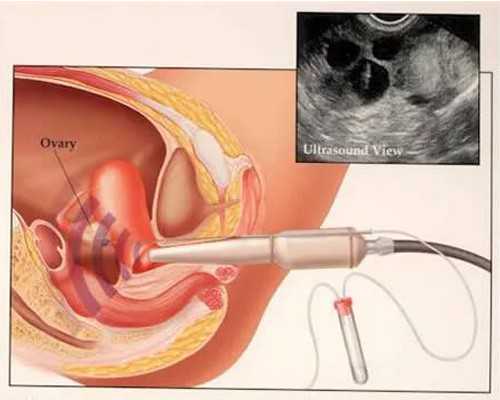 (a)代孕最低多少钱,广西私立医院供卵大概得多少钱(2026最新广西私立供卵机构排